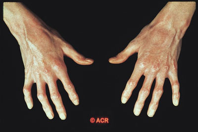 scleroderma-hand_jpg.jpg